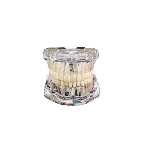 Transparent Cast